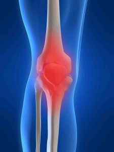 Kneed joint having Arthritis pain
